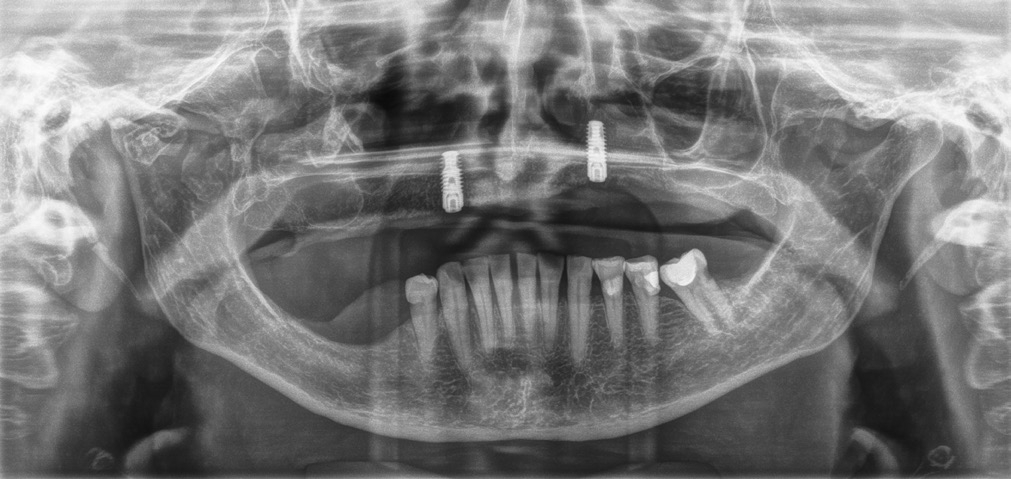 Abb. 3: Zustand nach Insertion von zwei SICmax-Implantaten im Oberkiefer.