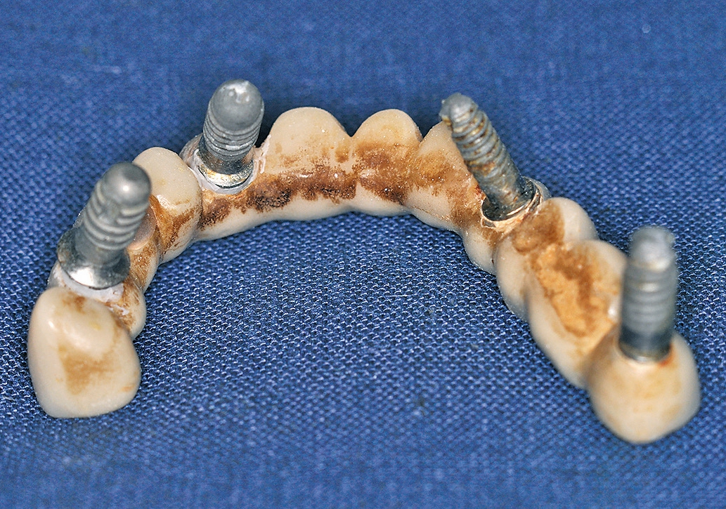 Abb. 4: Hygienisch ungünstig gestalteter Zahnersatz: Sattelförmig aufl iegende Pontics, massiver Konkrementbefall, Inkongruenzen und Passungenauigkeiten zwischen den Implantaten und den Kronen.