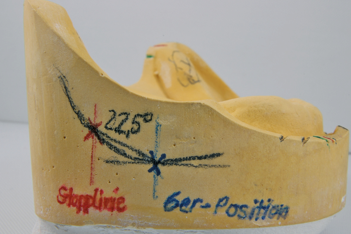 Abb. 3: Anzeichnung des Kieferkammprofils mit Analyse.