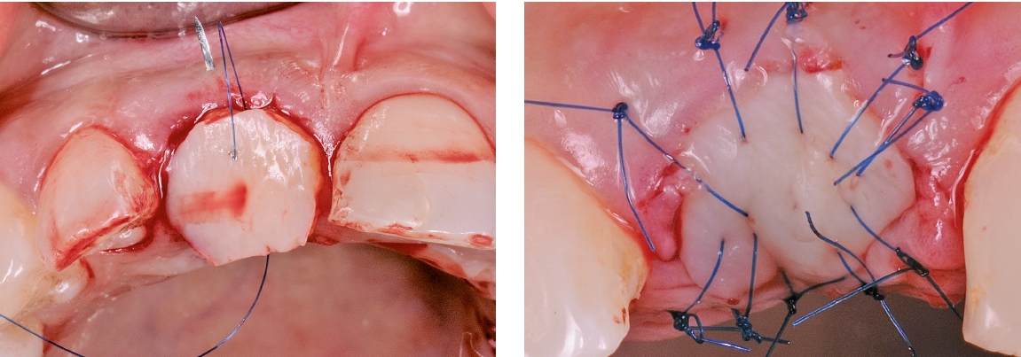 Abb. 5 und 6: Kombiniertes Bindegewebe-Epithel Transplantat.