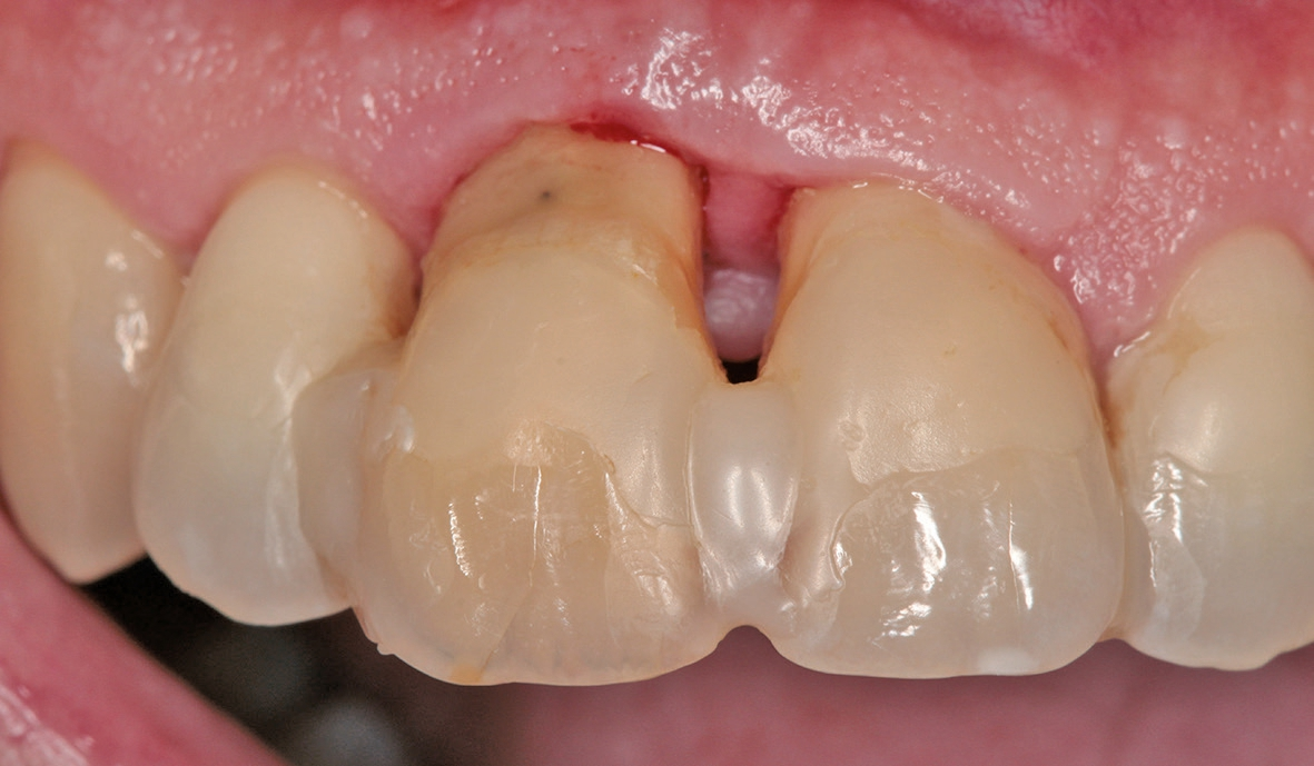 Abb. 3: Situation 14 Tage post OP.