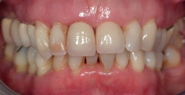 Abb. 1: Intraorale Aufnahme der Front vom 15.11.2017: lokalisierte Rötung und Schwellung der marginalen Gingiva. Es sind generalisierte, bräunlich-weißliche Beläge in der Ober- und Unterkieferfront zu erkennen.