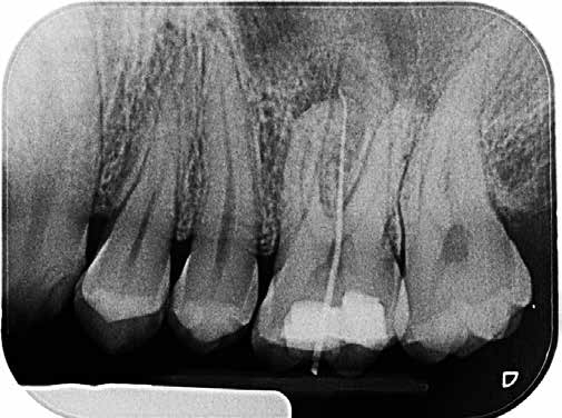 Abb. 3: Die diagnostische Röntgenaufnahme mit in den Fistelgang eingebrachtem Guttapercha-Stift.