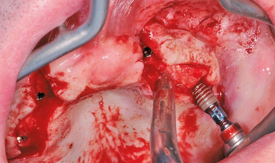 Abb. 3: Augmentation und Insertion von Straumann BLT-Implantaten.