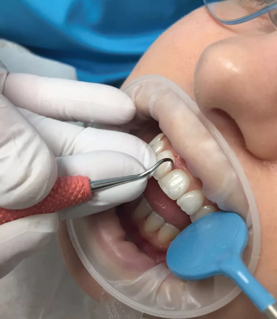 Scaling mit dem Montana-Jack Sichelscaler von Zantomed.