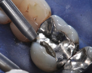 Abb. 3: Sandstrahlen mit Aluminiumoxid oder eine Silikatisierung der Reparaturoberfläche ermöglichen einen besseren Reparaturverbund als das alleinige Anrauen der Oberfläche mit Diamantschleifern.