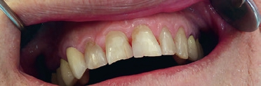Abb. 3: Deutlich verbesserte Mundhygiene und rückläufige Schwellung der Gingiva nach vierwöchiger Anwendung der Schallzahnbürste.