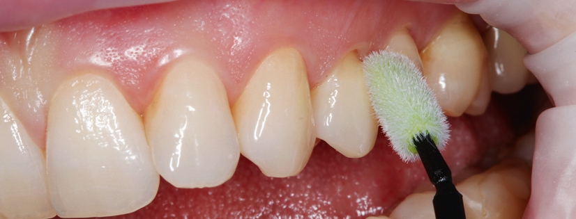 Abb. 3: Applikation eines Schutzlackes mit Chlorhexidin entlang des Gingivalsaums.
