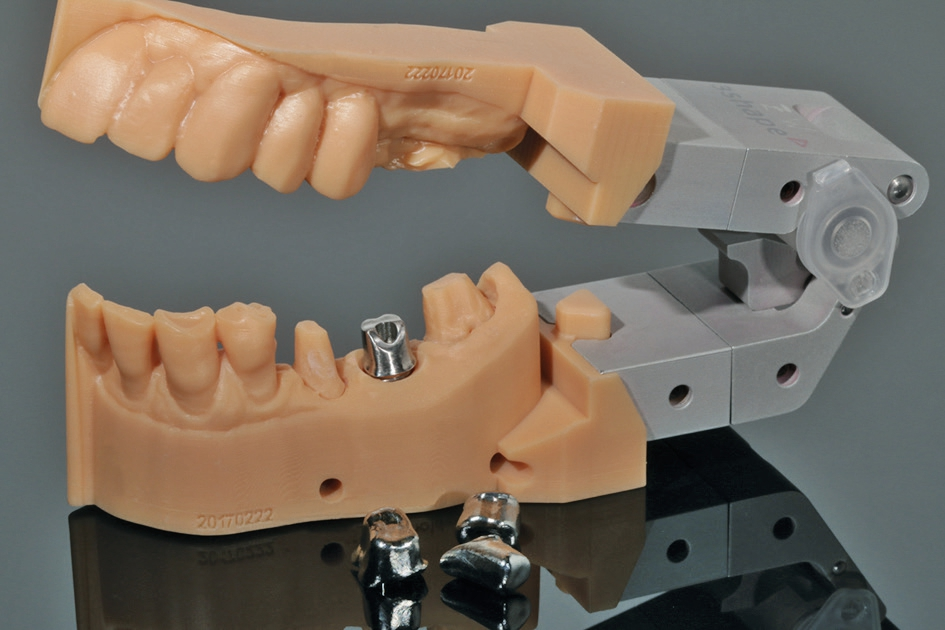 Abb. 4: Das individuelle Abutment…