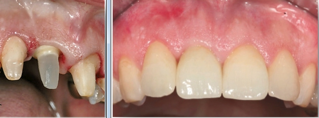 Abb. 9 und 10: Das Glasfaser-Abutment beim Champions BioWin! wird idealerweise mit Relyx Unicem (3M Espe) eingeklebt. Der Kronenrand liegt immer unterhalb der bakteriendichten Klebefuge und Komplikationen sind somit praktisch ausgeschlossen.