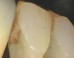 Abb. 3: Abrasionen interdental an Unterkieferfrontzähnen durch die Verwendung von Interdentalbürsten im Zusammenspiel mit Zahnpaste.