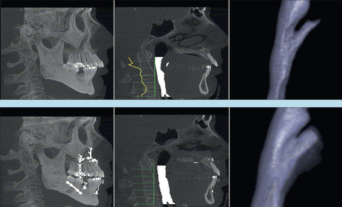 Abb. 3: Digitale Volumentomografie vor und nach maxillo-mandibulärem Advancement zur Therapie der obstruktiven Schlafapnoe. Die obere Reihe zeigt die präoperative Bildgebung mit einem engen posterior airway space (dreidimensionale Segmentierung). Die untere Reihe zeigt die postoperative Röntgenkontrolle mit relevanter Erweiterung der oberen Atemwege.