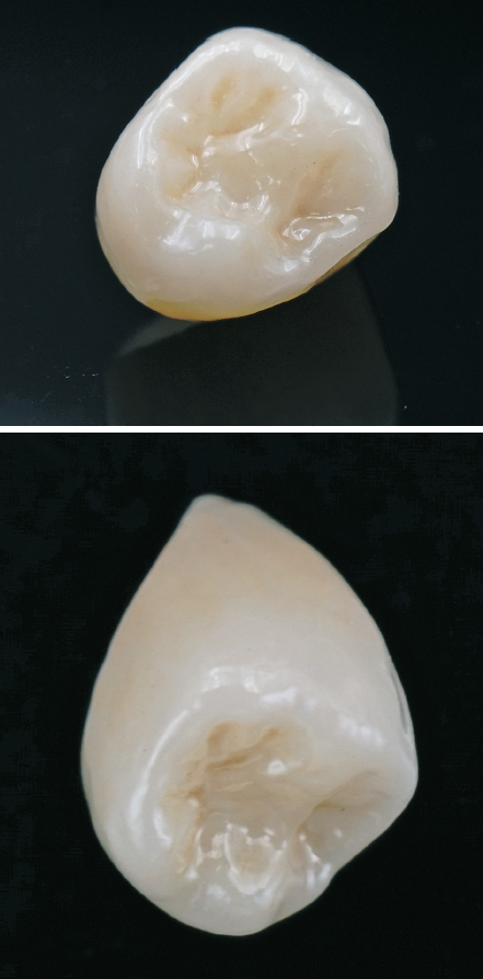 Ästhetisch stark: Prämolarenkrone aus extra transluzentem Zirkoniumdioxid (Cercon xt) mit Malfarben charakterisiert.