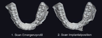 Abb. 3: Intraoralscans zur prothetischen Implantatversorgung regio 34, 35.