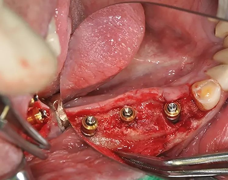 Abb. 4: Endgültiges Einbringen der Zwischenabutments
während der Implantatoperation.