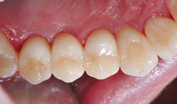 Abb. 4: Prothetische Versorgung mit e.max-Kronen (Ivoclar Vivadent).