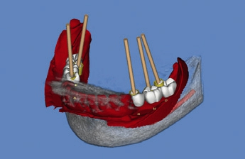 Abb. 4: Ein virtuelles Wax-Up mit Implantatachse.