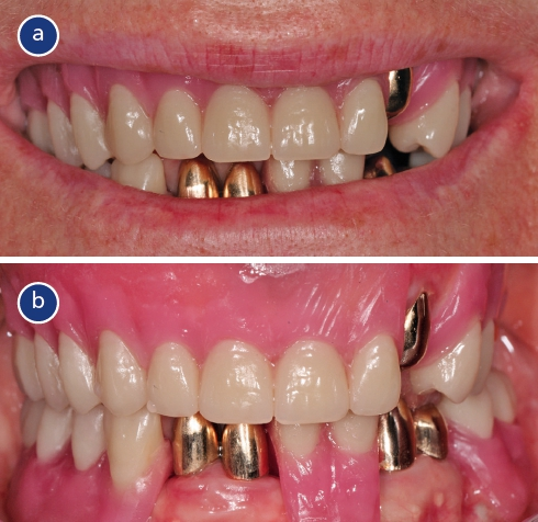 Abb. 4: Set-up der zukünftigen Endsituation lächelnd (a) und mit zurückgezogenen Lippen (b).