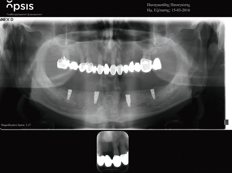 Abb. 5: Übersichtsaufnahme post OP.