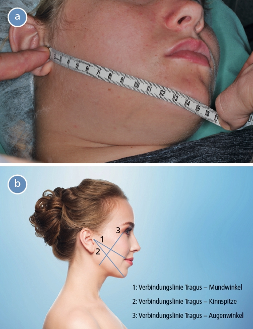 Abb. 4a und b: Messung der postoperativen Schwellung.
