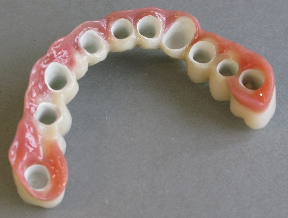 Abb. 3: Langspannige Brücke mit Gingivamasse individualisiert. Abb. 3-5, 18 © Vario Dental, München