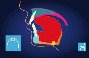 Abb. 4: Die Abbildung zeigt die physiologische Zungenruhelage, aus der unter Zahnkontakt und beidseitiger Kontraktion des M. masseter geschluckt wird. Dabei hebt sich die Zunge gegen den Gaumen und formt den Zahnbogen gut aus – eine breite Nasenbasis und Nasenatmung sind die physiologischen Folgen. Die Kaumuskeln werden bei jedem Schlucken trainiert, sodass das Kind gut abbeißen und kauen kann. Es kann zudem klar und deutlich sprechen und sich richtig hören, wodurch die Sprachproduktion im Gehirn positiv unterstützt wird. (Abbildung: Mary Ann Bolten)