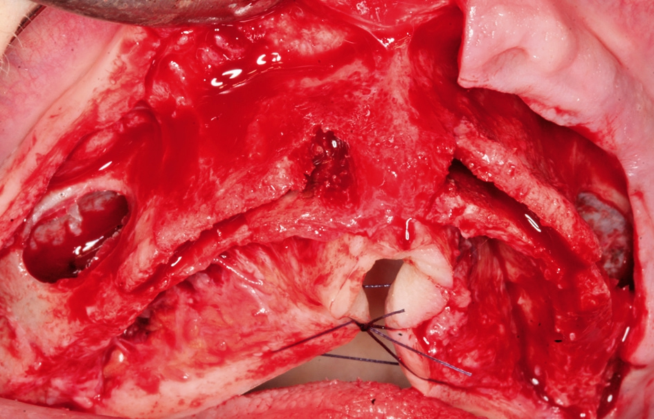 Abb. 4: Sinusbodenelevation und Bone Splitting mit Präparation eines Mukoperiostlappens.