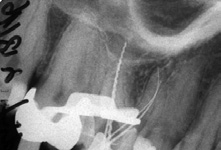 Abb. 2a: Im orthoradialen Strahlengang sind mb1 und mb2 meistens übereinander projiziert.