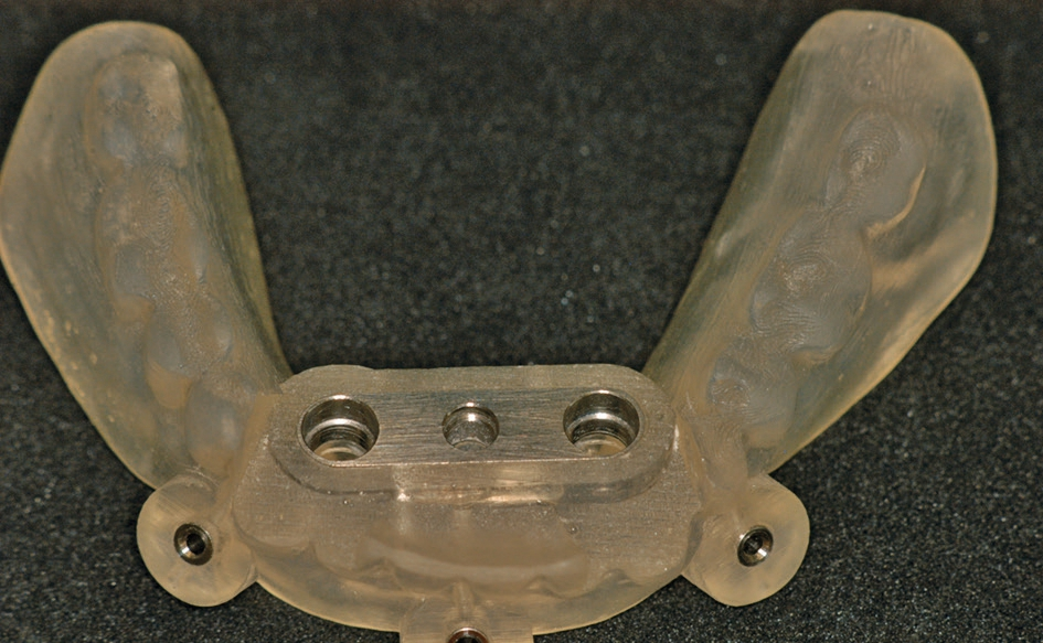 Abb. 4: Die fertige SOS-Schablone wird nach der Online-Bestellung von Medentis oder Dentsply geliefert.