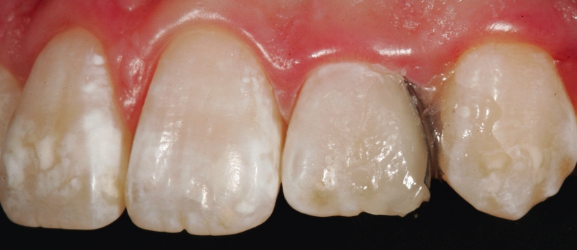 Abb. 4: Der aus der Dentinfarbe D2 aufmodellierte Dentinkern distal an Zahn 22.