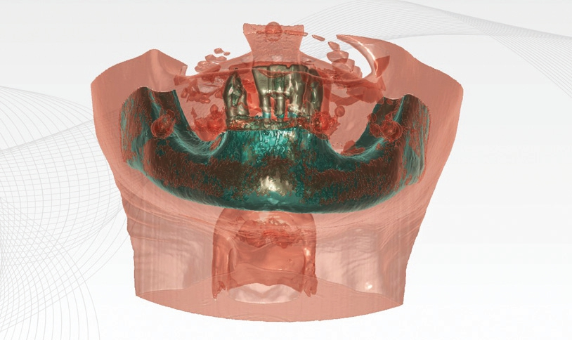 Abb. 4: Knochenhöhe intraforaminal.