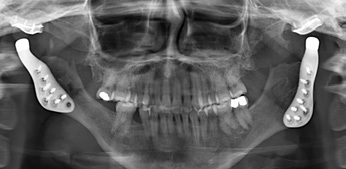 Abb. 5: Basierend auf den Daten der Computertomografie des Schädels wurden CAD-/CAM-gestützt Endoprothesen für den Unterkiefer der jungen Frau hergestellt. Damit konnte die Position des Unterkiefers vor der Einschmelzung der Gelenke wiederhergestellt werden; in der gleichen Operation wurde die Position des Oberkiefers der jetzt idealen Stellung des Unterkiefers angepasst.
