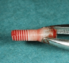 Abb. 4: Bei der Implantatentfernung frakturierte der osseointegrierte apikale Anteil des Implantats.