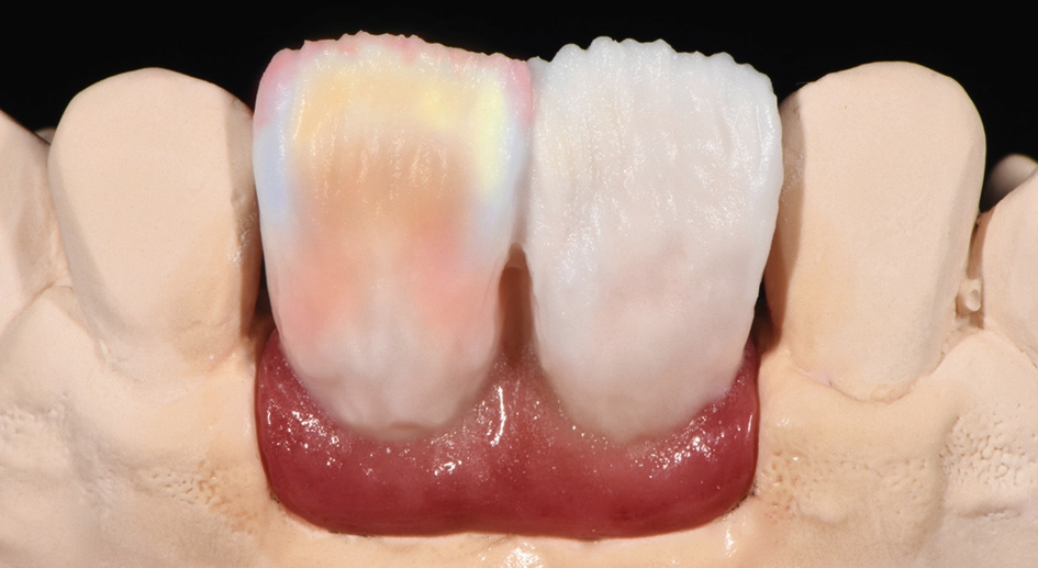 Abb. 4: Danach wurden (4) IPS e.max Ceram Special Incisal grey und Cervical Transpa orange und (5) IPS e.max Ceram Selection Special Enamel quartz (SE qu) und IPS e.max Ceram Opal 2 (OE2) aufgetragen, um die Tiefe des Zahnhalses zu imitieren. Für die Charakterisierung der Inzisalkante wurden verwendet: (6) IPS e. max Ceram Mamelon light, (7) IPS e.max Ceram Selection LA salmon, (8) IPS e.max Ceram OE 1, (9) IPS e.max Ceram Selection LA taupe, (10) IPS e.max Ceram Power Incisal und (11) IPS e.max Ceram Deep Dentin (DD) BL3+OE2.