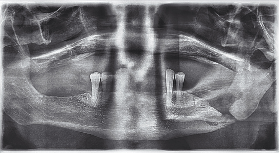 Abb. 5: Die pathologische Unterkieferfraktur links ist gut im Orthopantomogramm zu erkennen.