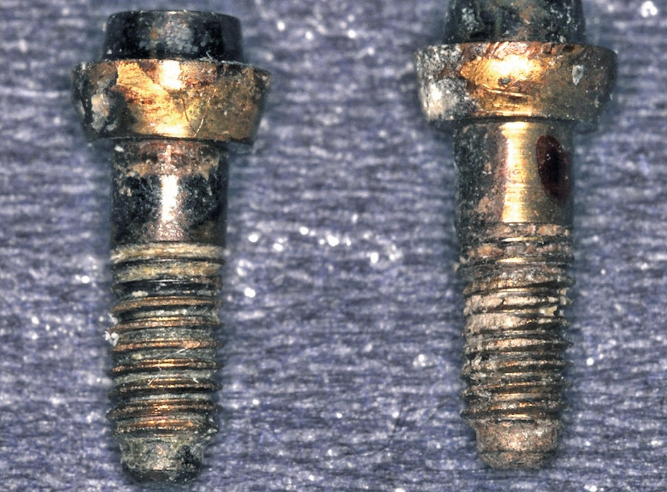 Abb. 4: Deutlich sichtbare Goldionenablagerung nach 30 Jahren auf Titanabutments von IMZ-Implantaten (IMZ = intramobiles Zylinderimplantat).