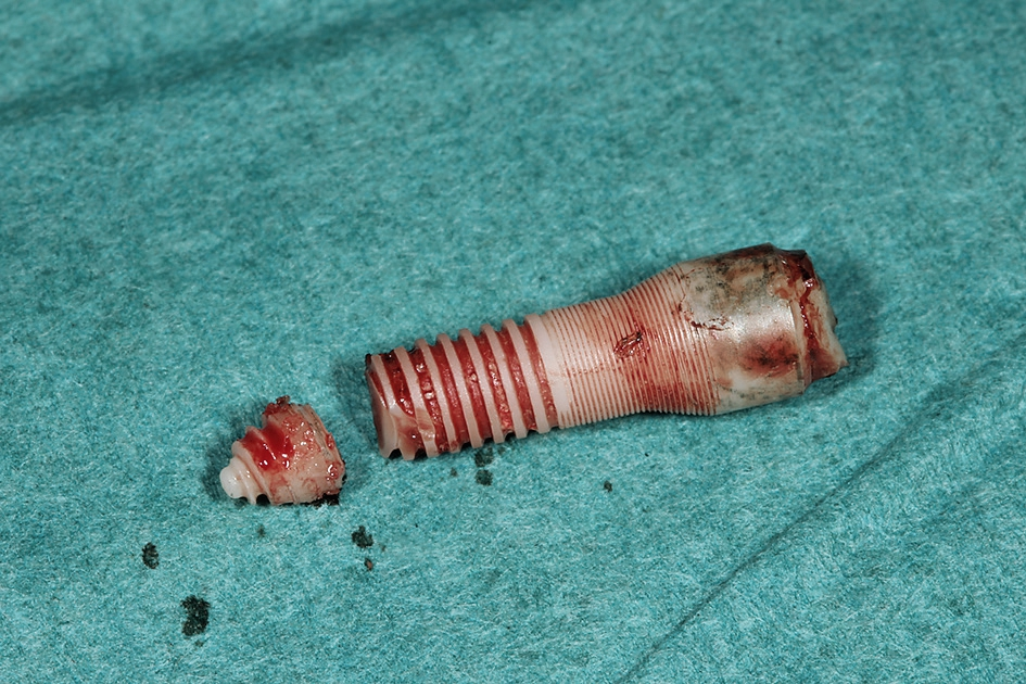 Abb. 4: Die Fragmente wurden zur Kontrolle der Vollständigkeit des explantierten Implantats aneinandergelegt.