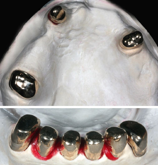 Abb. 4 u. 5: OK- und UK-Primärteleskope nach der Überabformung mit individuellem Löffel auf dem Meistermodell.