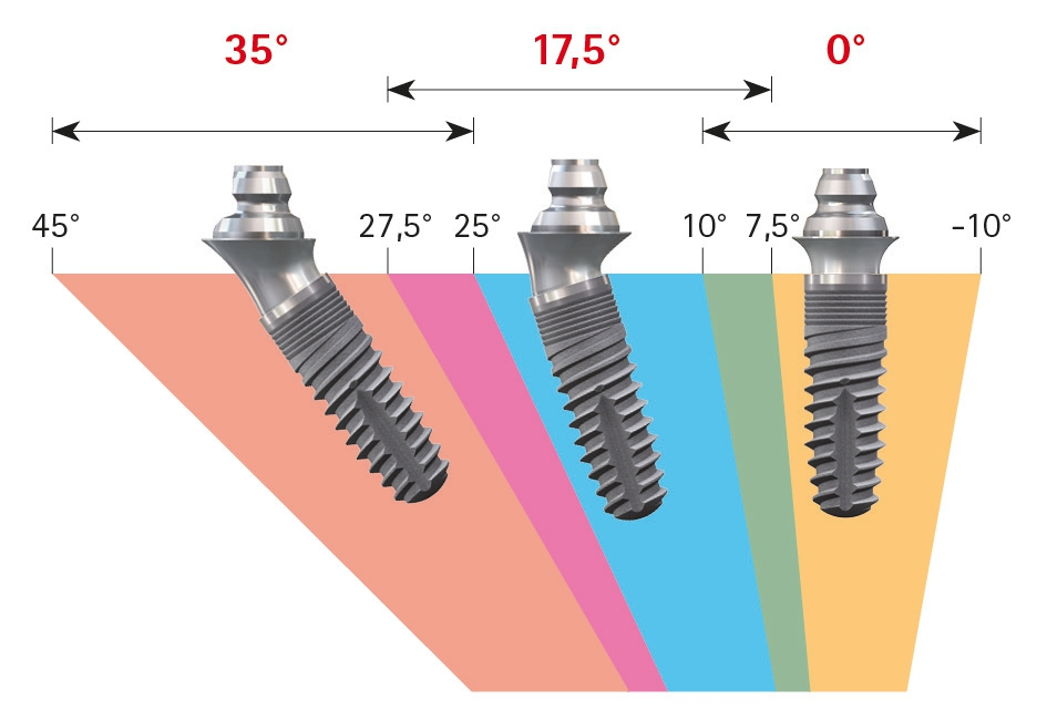 Abb. 6: Ausgleich der Achsendivergenzen durch entsprechende Abutments.