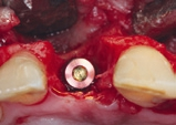 Abb. 5: Inseriertes Implantat (SKY Narrow).
