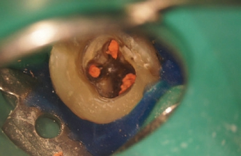 Abb. 4: Obturation mit F360-Guttaperchaspitzen und EasySeal.