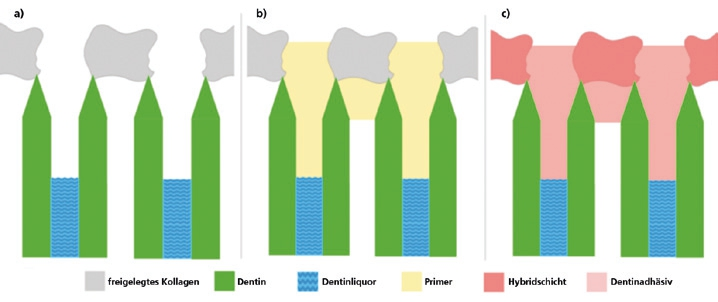 Abb. 3: Skizzierung der einzelnen Vorbehandlungsschritte der Dentinhaftvermittlung: a) Zustand nach Konditionierung mit Phosphorsäure, b) Auftragen des Primers, c) gebildete Hybridschicht (Kollagen/Primer/Adhäsiv) nach Aufbringen des Dentinadhäsivs.