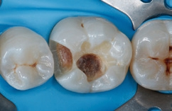 Abb. 4: Isolation des Behandlungsgebiets mit Kofferdam.