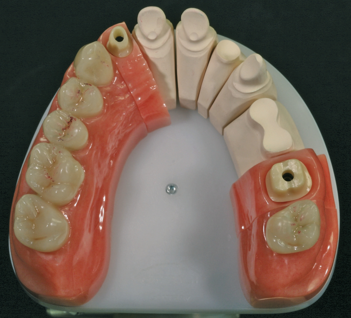Abb. 2c: Die Implantataufbauten auf dem Modell.