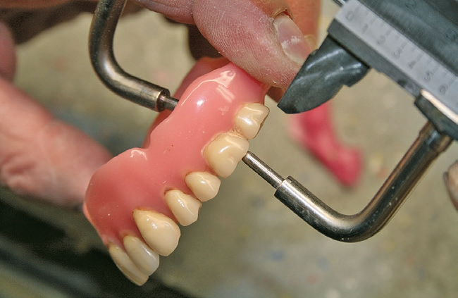 Abb. 2c: Höhenmaß an Zahn 26.