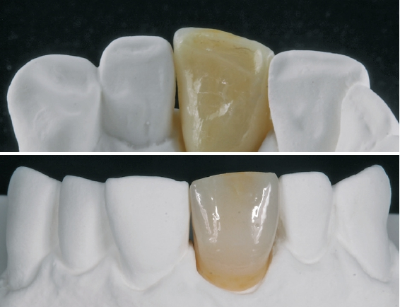 Abb. 4a u. b: Die fertige Krone von lingual und labial: Nach der Dentin-Schneide-Schichtung werden charakteristische Merkmale mit Malfarben angelegt.