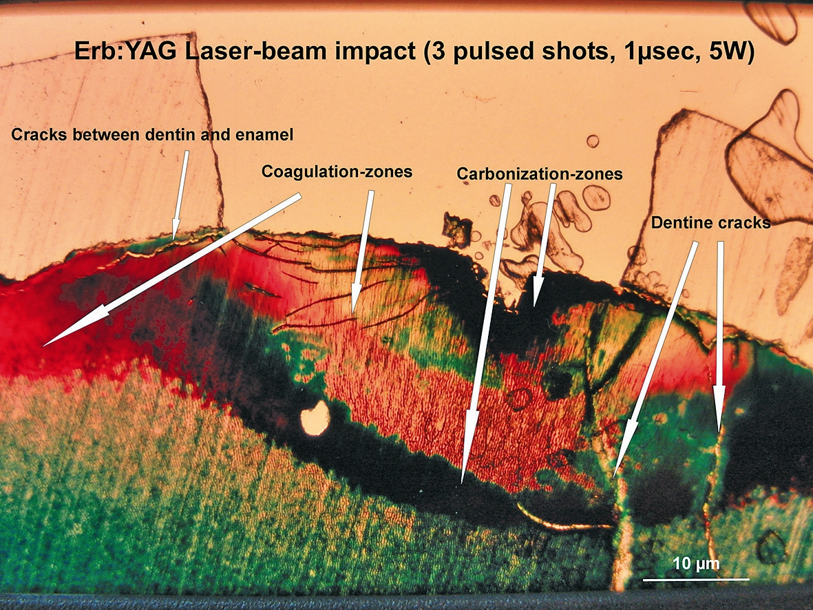 Abb. 4: Histologie eines frisch extrahierten Zahnes, der an der Schmelz-Dentin-Grenze mit drei Pulsen eines Er:YAG-Lasers bearbeitet wurde (Azan-Färbung). Koagulations- und Karbonisationszonen sind deutlich sichtbar sowie Strukturbrüche im Dentin und in der Verbindungszone zwischen Schmelz und Dentin, verursacht durch die photoakustischen Schalldruckwellen.
