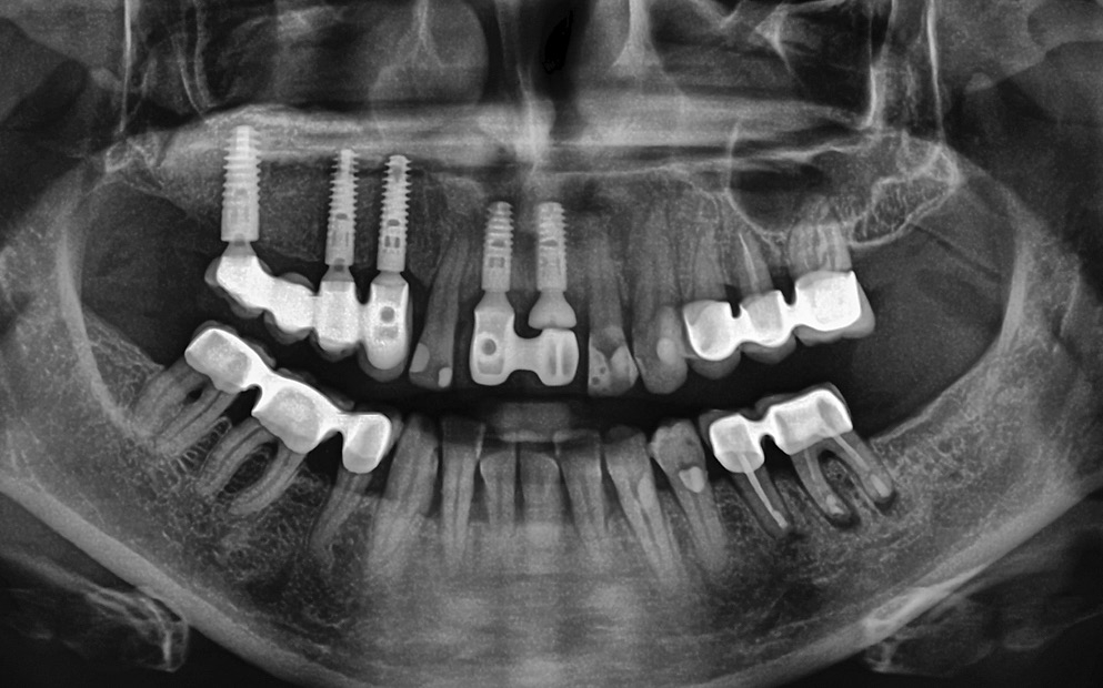 Abb. 4: Zeit nach Implantatinsertion und kurz vor Fertigstellung der Implantatprothetik.