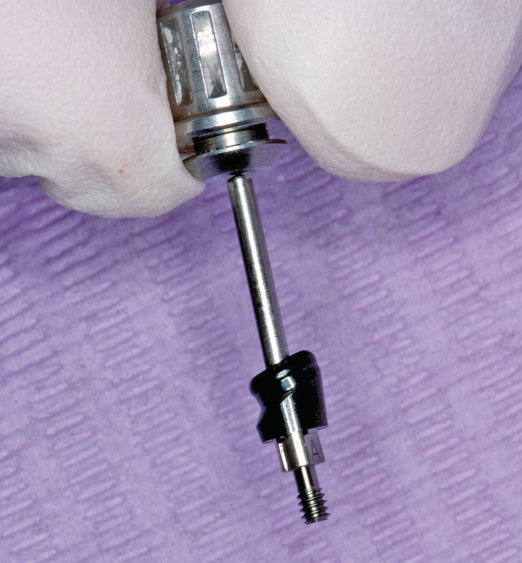 Abb. 6: Abgewinkeltes Novaloc® Sekundärteil 15°.