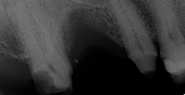 Nach Entfernen der Krone war klinisch distal, in Höhe des Kronenrandes, eine Karies diagnostiziert worden. Diese wurde mit Carisolv und dem PolyBur P1 entfernt. Nach Anwendung der selbstlimitierenden Therapie wurde ein Einzelzahn-Röntgenbild angefertigt, um die restliche Zahnhartsubstanz unmittelbar vor dem Nerv darzustellen.